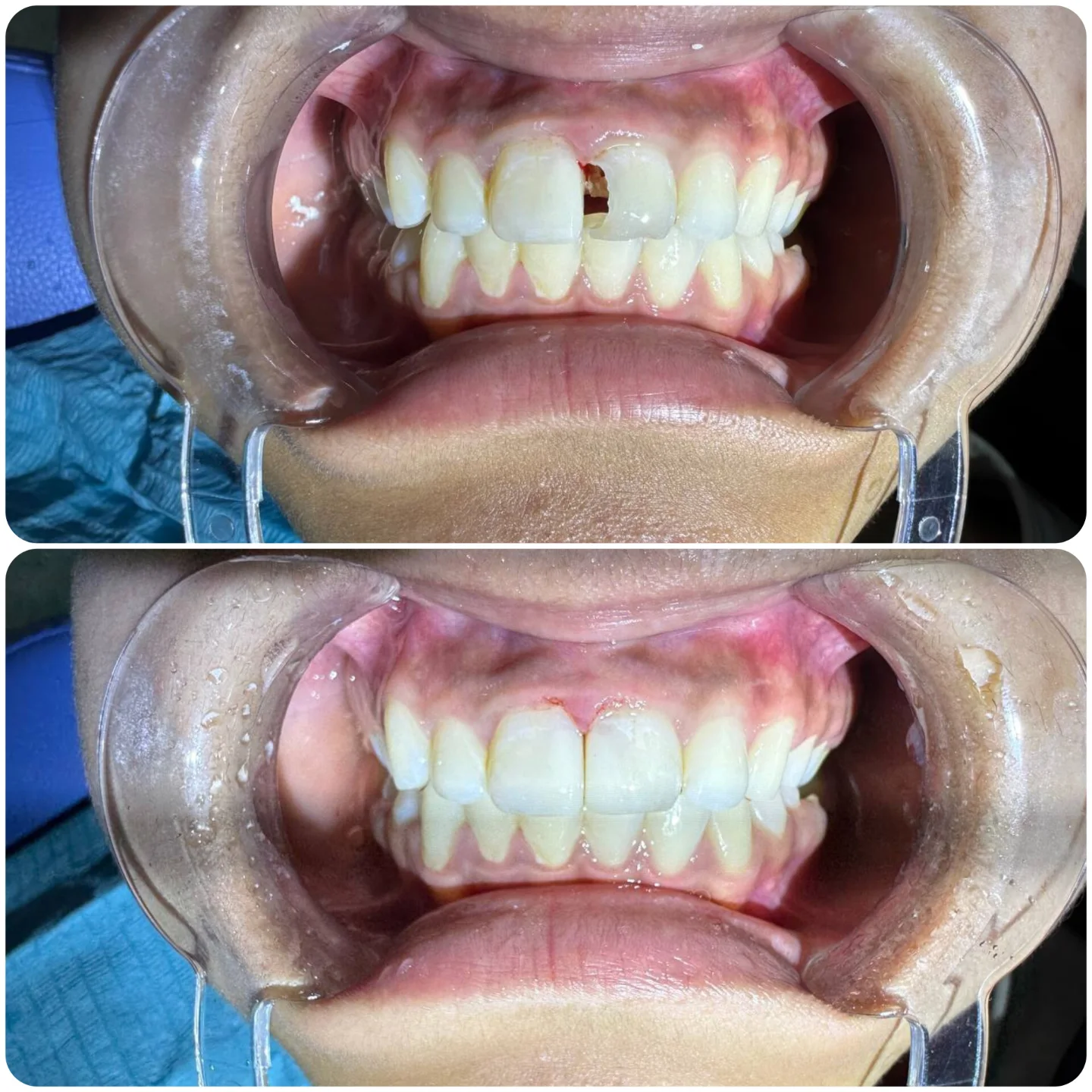 Эстетические пломбы